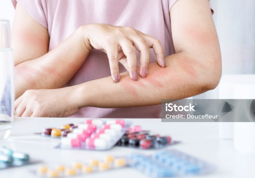 DRUG ALLERGY DRUG ALLERGY