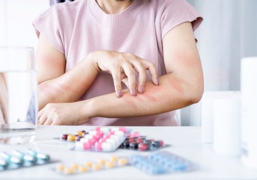 A Woman Experiencing Allergic Reaction to Medication, Scratching Itchy Skin on Arm due to Side Effect